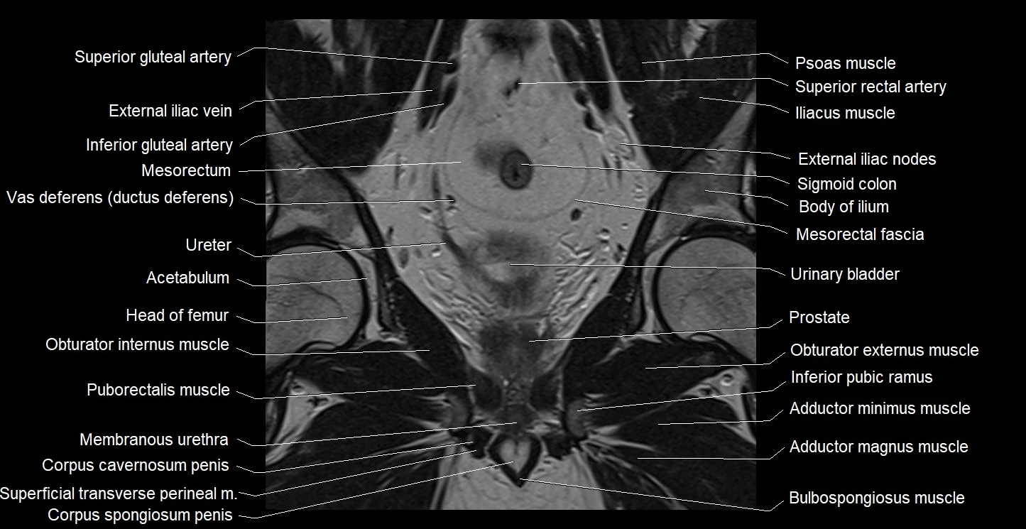 MRI coronal cross sectional anatomy male pelvis image 20.webp